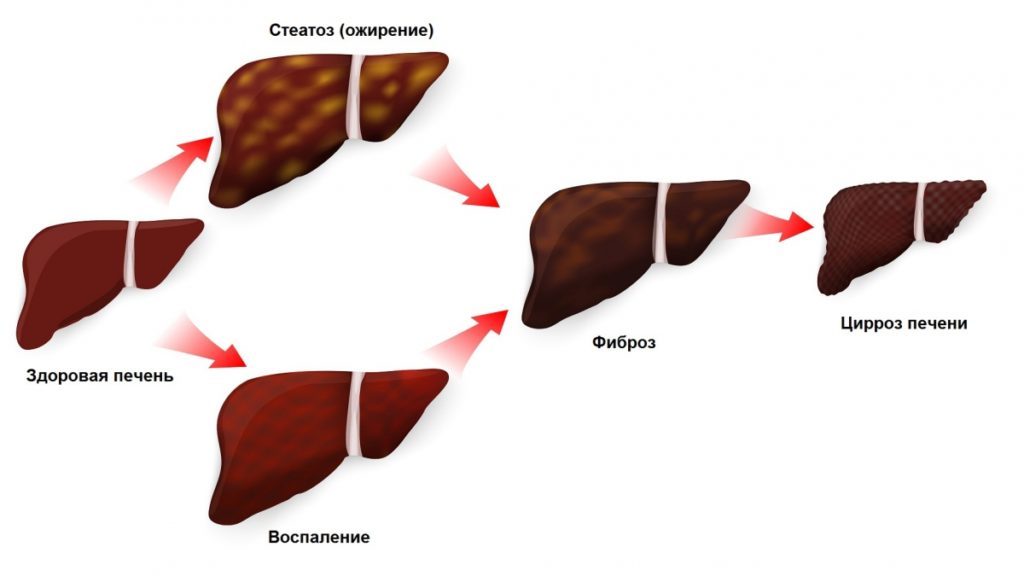 Как лечить гепатит С с фиброзом печени