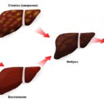 Как лечить гепатит С с фиброзом печени